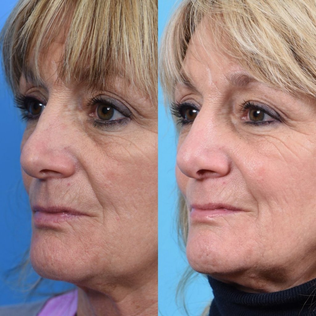 female patient before and after rhinoplasty - left side