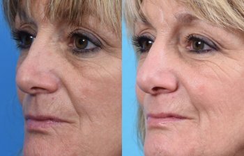 female patient before and after rhinoplasty - left side