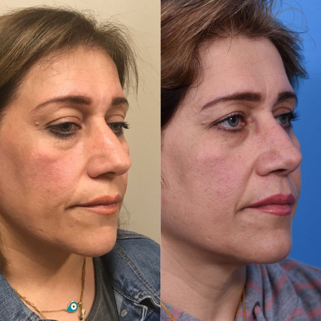female patient before and after rhinoplasty - right side