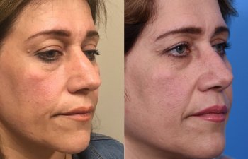 female patient before and after rhinoplasty - right side
