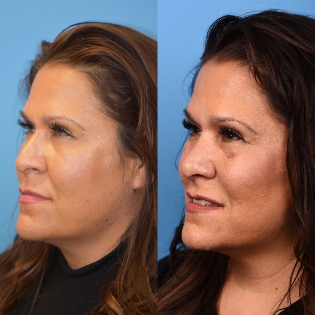 female patient before and after rhinoplasty - left side