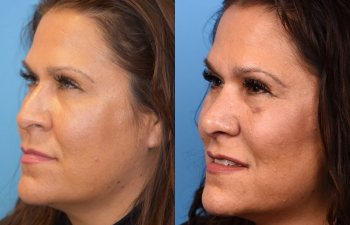 female patient before and after rhinoplasty - left side