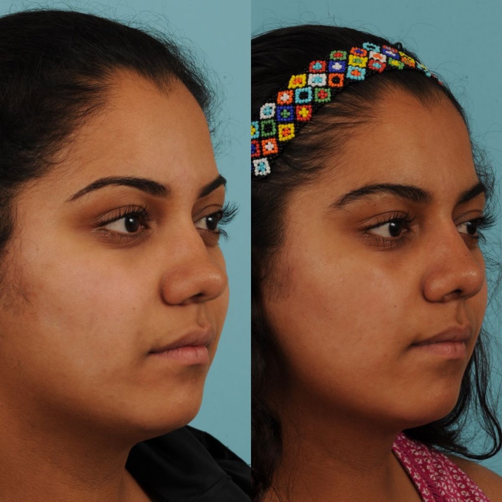 female patient before and after rhinoplasty - right side