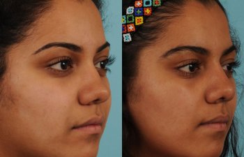 female patient before and after rhinoplasty - right side