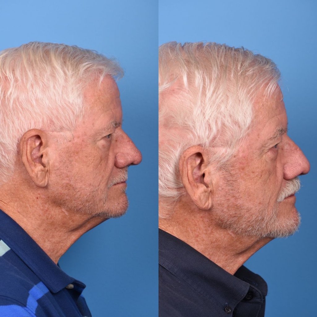 male patient before and after nasal reconstructive surgery