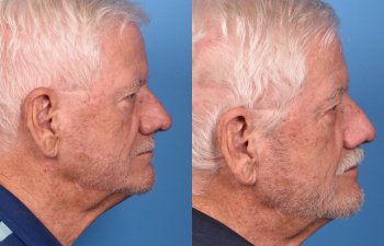 male patient before and after nasal reconstructive surgery