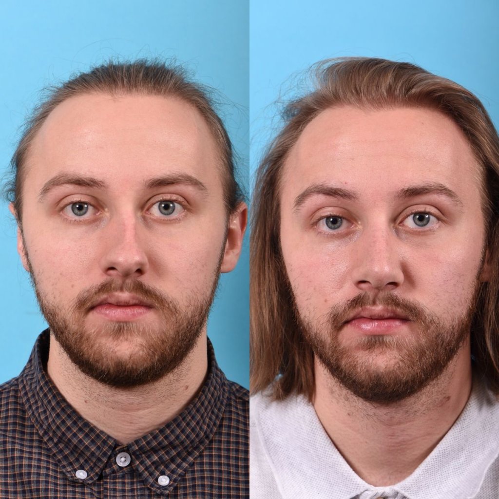 male patient before and after rhinoplasty - front