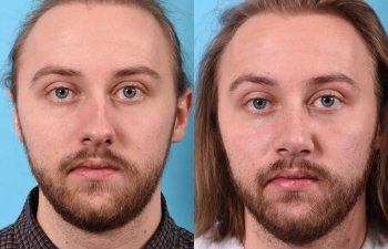 male patient before and after rhinoplasty - front