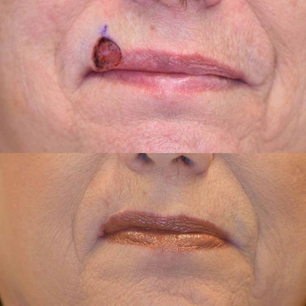 patient before and after upper lip MOHS reconstructive surgery
