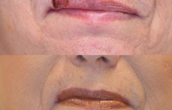 patient before and after upper lip MOHS reconstructive surgery