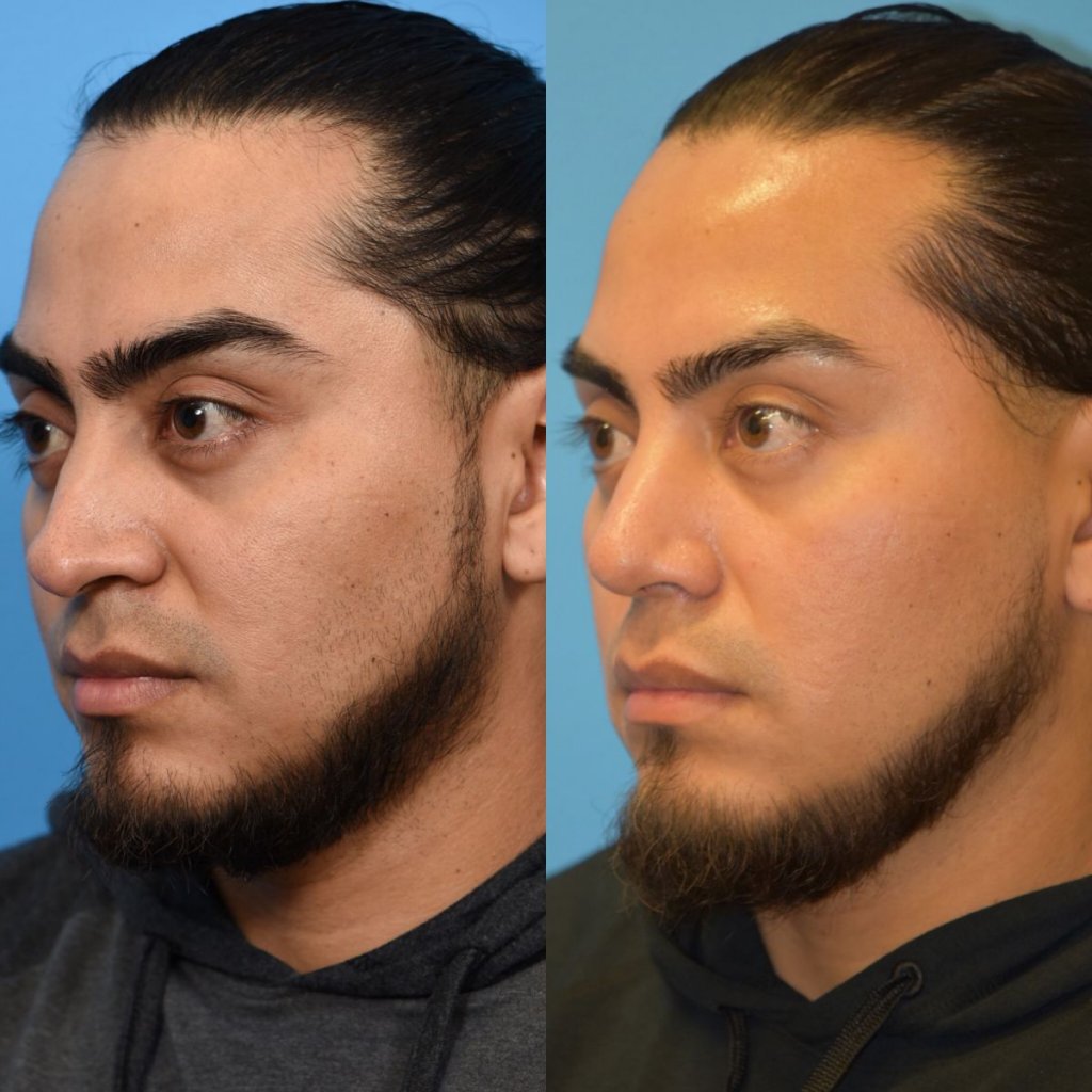male patient before and after rhinoplasty - left side