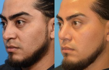 male patient before and after rhinoplasty - left side