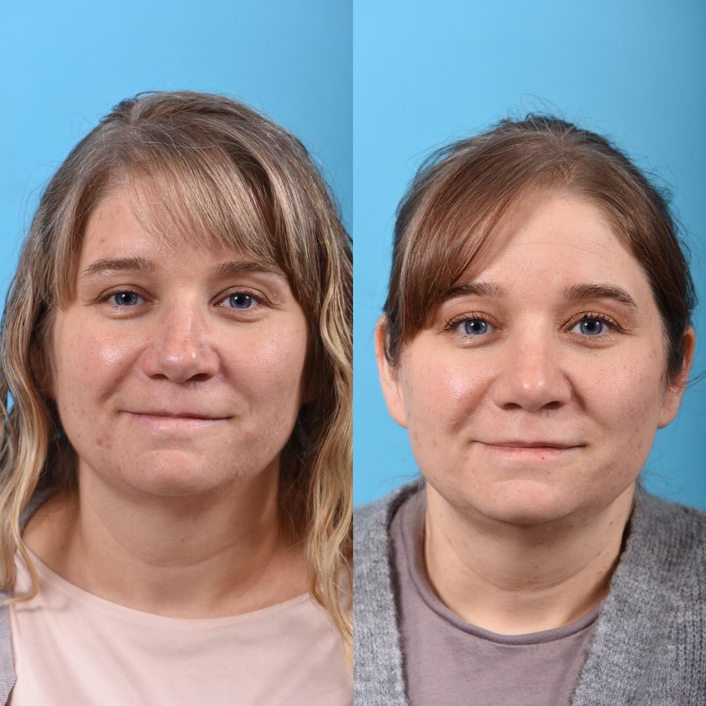 female patient before and after rhinoplasty - front