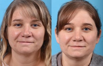 female patient before and after rhinoplasty - front