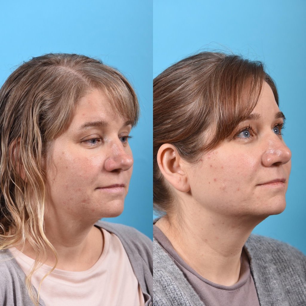 female patient before and after rhinoplasty - right side
