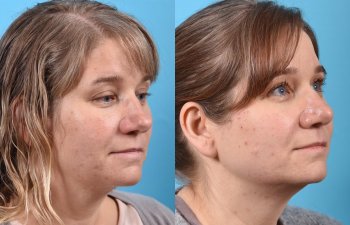 female patient before and after rhinoplasty - right side