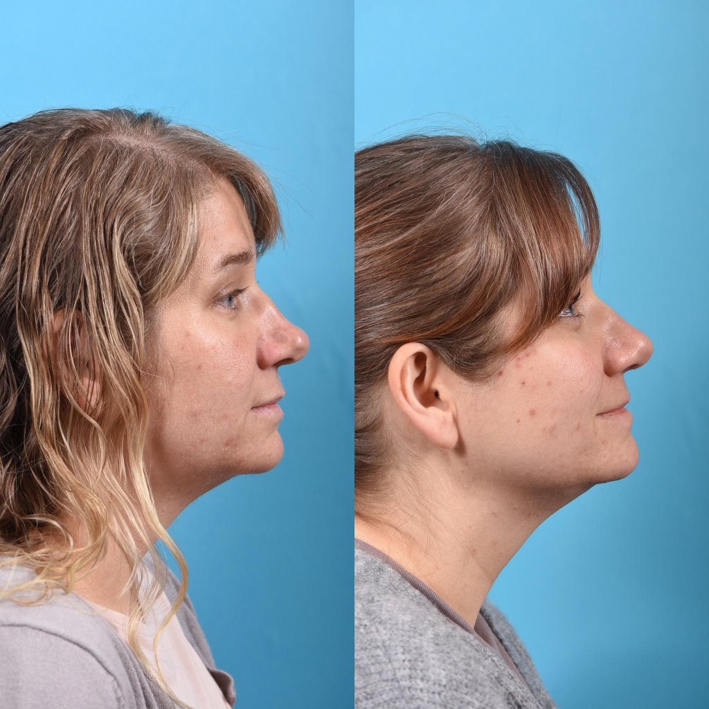 female patient before and after rhinoplasty - right side