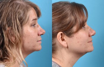 female patient before and after rhinoplasty - right side