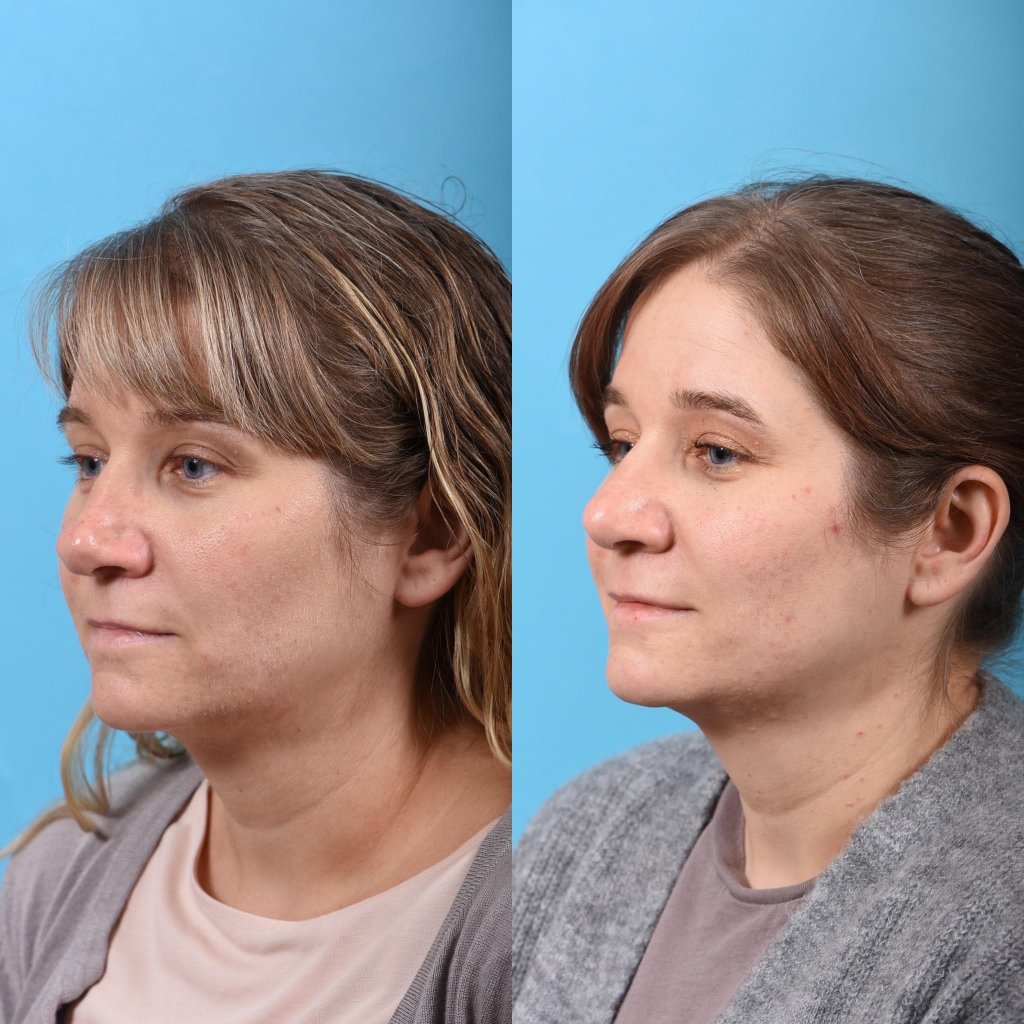 female patient before and after rhinoplasty - left side