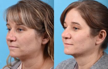 female patient before and after rhinoplasty - left side