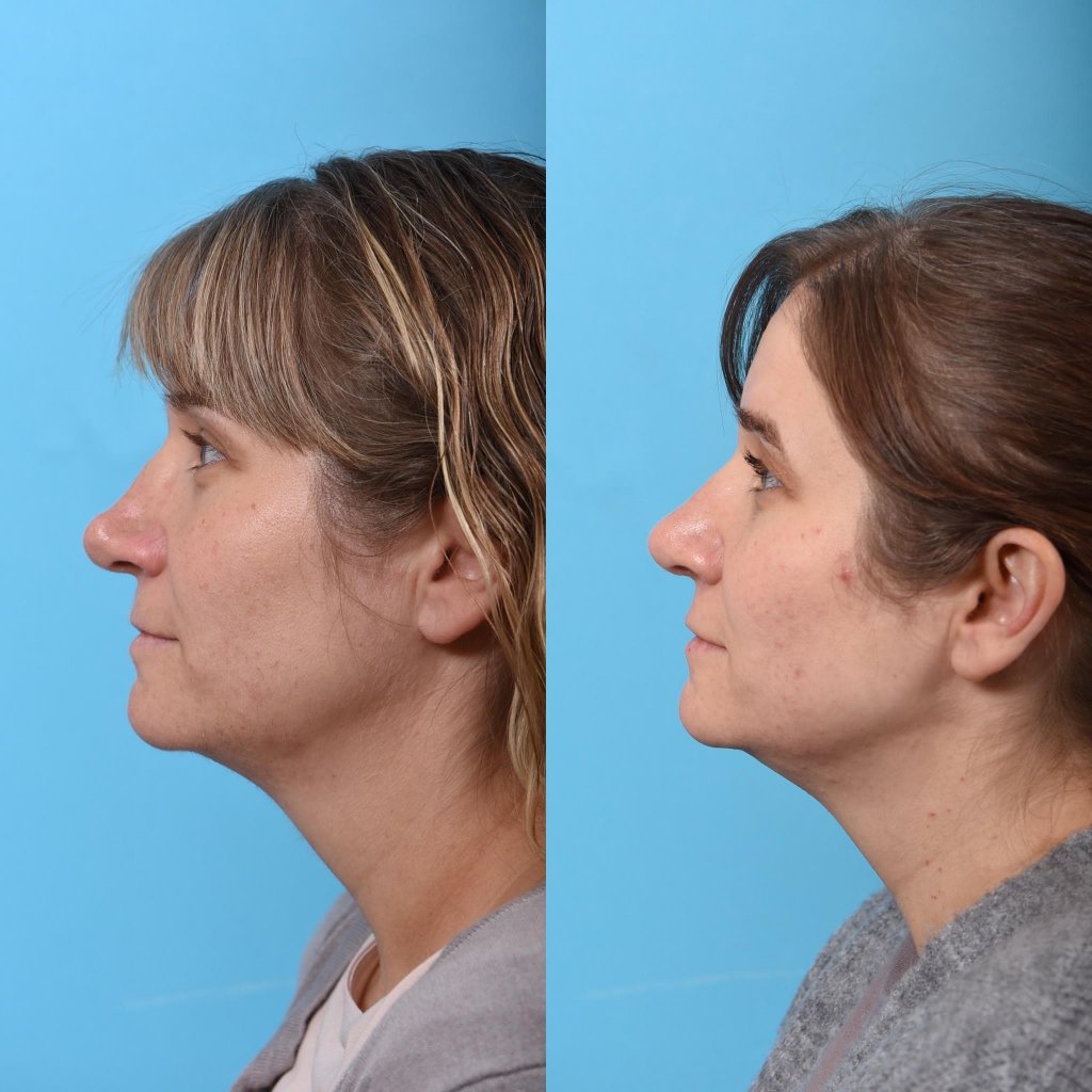 female patient before and after rhinoplasty - left side