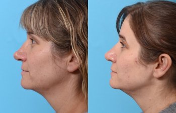 female patient before and after rhinoplasty - left side