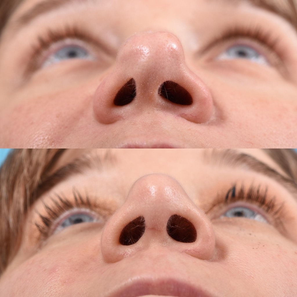 female patient before and after rhinoplasty - front
