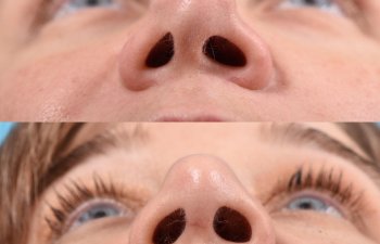 female patient before and after rhinoplasty - front