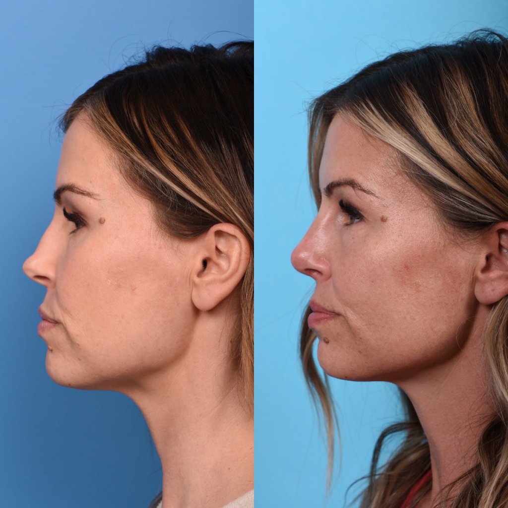 Female patient Rhinoplasty before and after - left side.