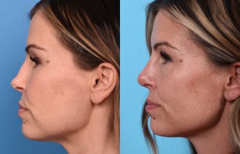 Female patient Rhinoplasty before and after - left side.