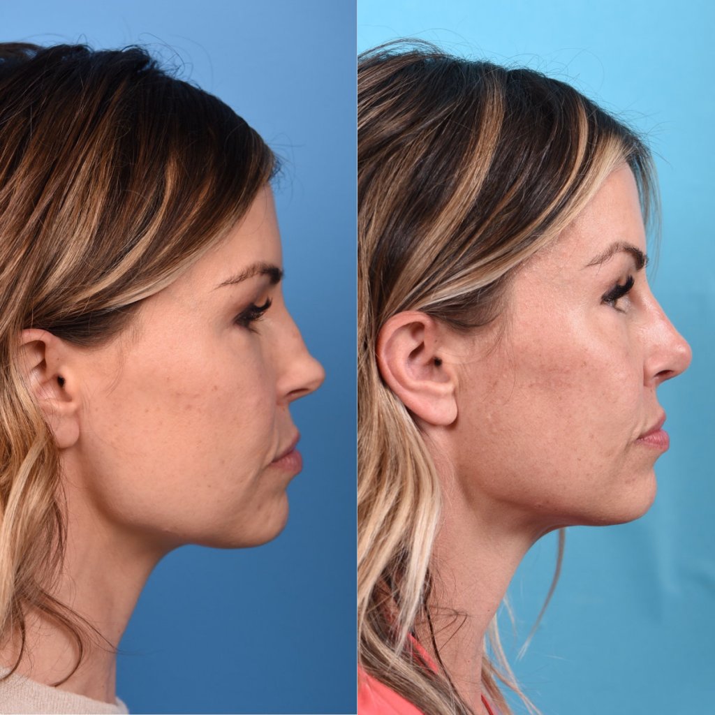 Female patient Rhinoplasty before and after - right side.