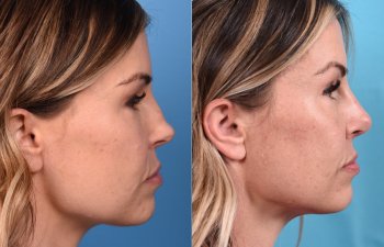 Female patient Rhinoplasty before and after - right side.