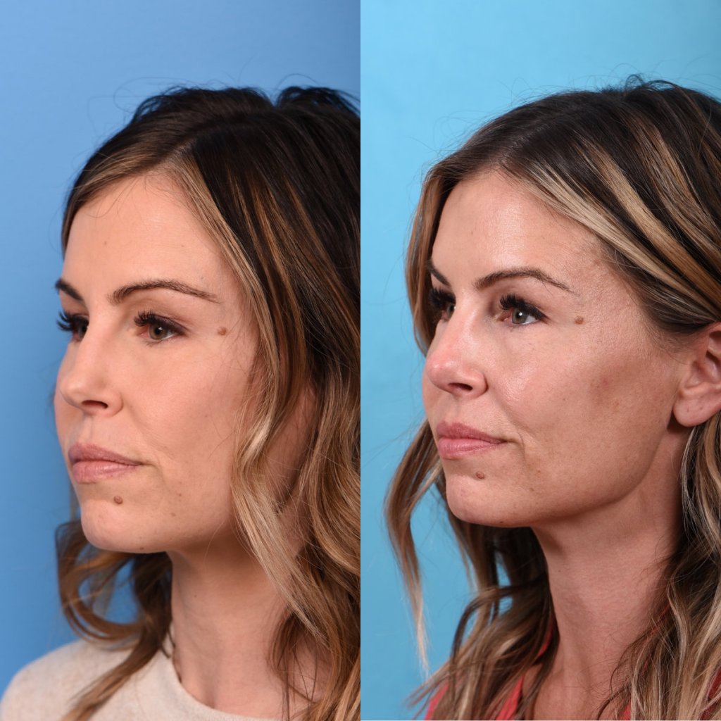 Female patient Rhinoplasty before and after - left side.