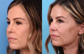 Female patient Rhinoplasty before and after - left side.