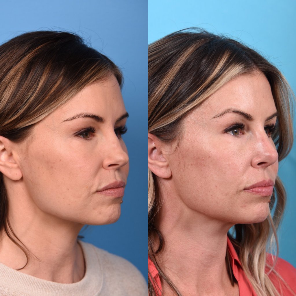 Female patient Rhinoplasty before and after - right side.
