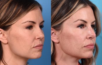 Female patient Rhinoplasty before and after - right side.