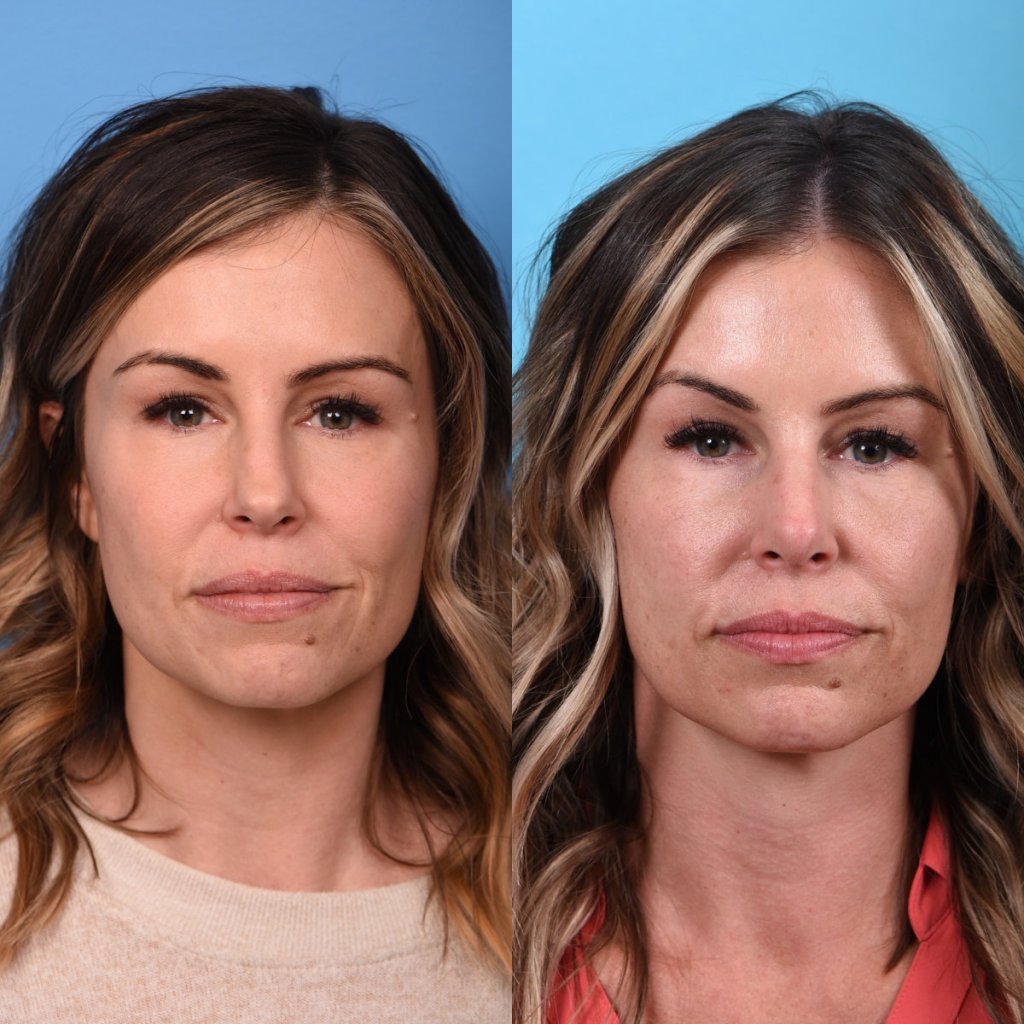 Female patient Rhinoplasty before and after - front.
