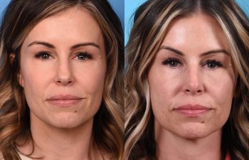 Female patient Rhinoplasty before and after - front.