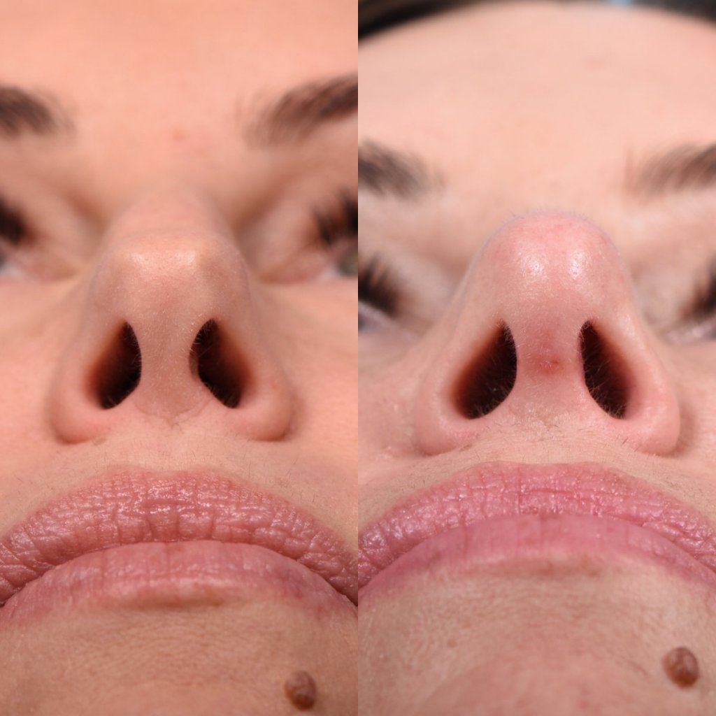 Female patient Rhinoplasty before and after - front.