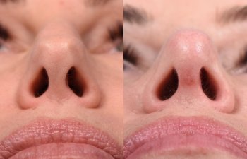 Female patient Rhinoplasty before and after - front.