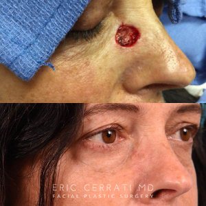 Woman Before and After Reconstruction Surgery