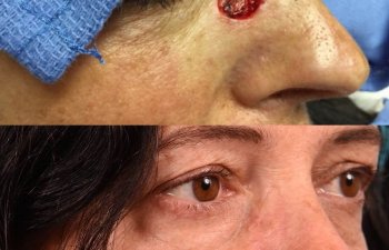 Woman Before and After Reconstruction Surgery