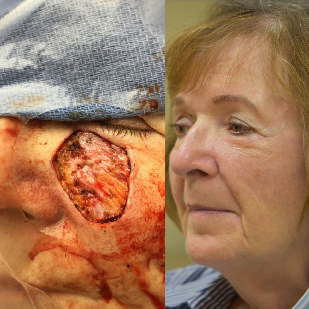 Old woman before and after reconstruction surgery