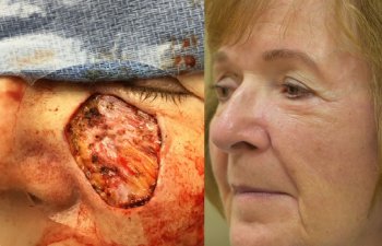 Old woman before and after reconstruction surgery