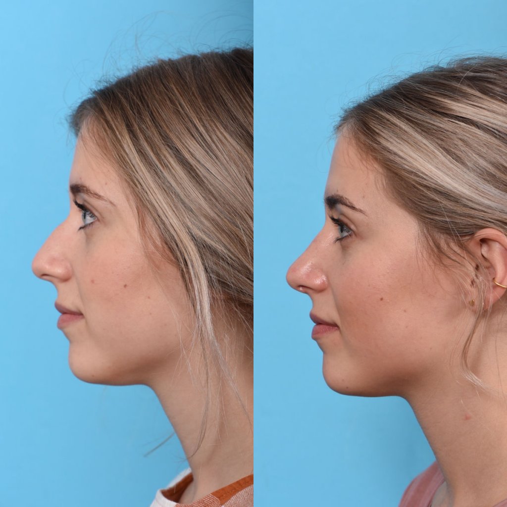 Young female patient Rhinoplasty before and after - left side.