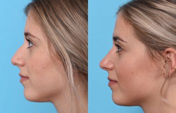 Young female patient Rhinoplasty before and after - left side.