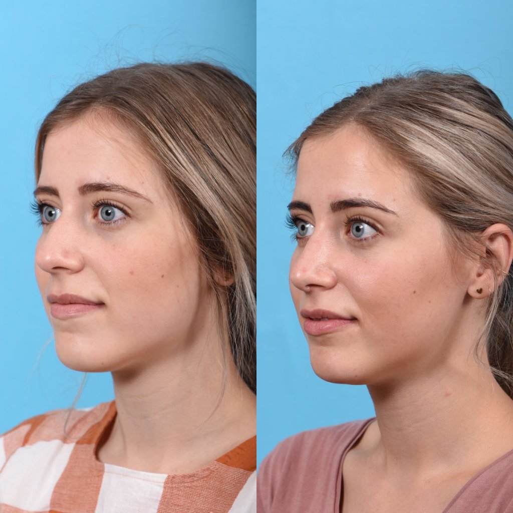 Young female patient Rhinoplasty before and after - left side.