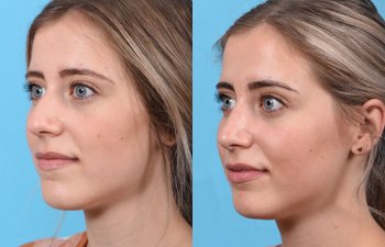 Young female patient Rhinoplasty before and after - left side.