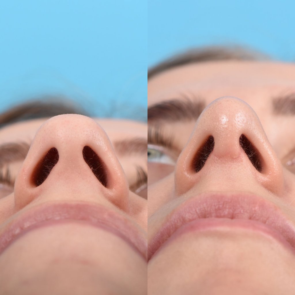 Young female patient Rhinoplasty before and after - front.