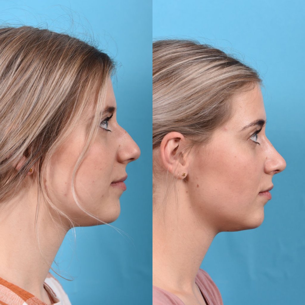 Young female patient Rhinoplasty before and after - right side.